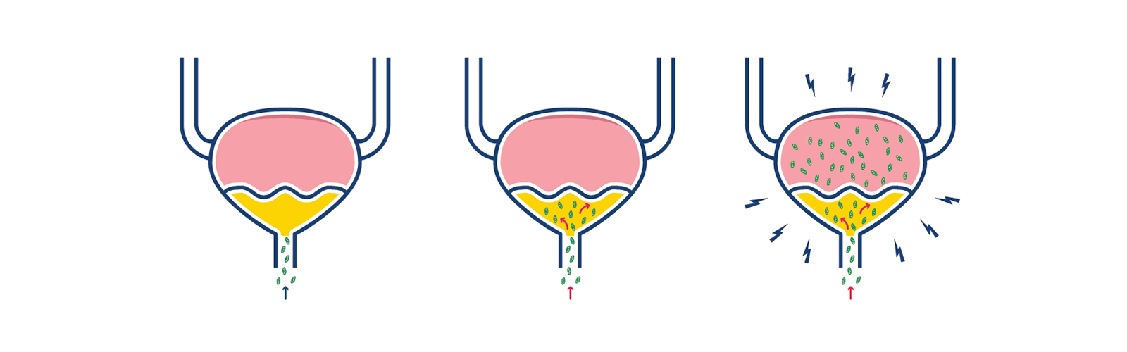 Illustration de la manière dont les bactéries infectent la vessie lors d’une infection urinaire Illustration de la manière dont les bactéries infectent la vessie lors d’une infection urinaire